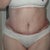 post op day 18