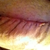 the scar is swollen look how bad it puckers