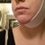 chin lipo garment and swelling day 2