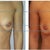 Comparison 1 month after OP (left) with 2 weeks after  (right)