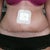Day 15 PO still very swollen and circular plaster is where they syringed me