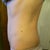 6 Months PO