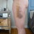 Day 5 - Left side bruises