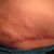 Very Painful 6 Months Post
