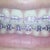 Lilac colored ligatures just for fun while I still have my braces on. 17 months into treatment. Some of my teeth were contoured to straighten out some of the edges.