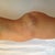 1 day post op side view