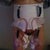 Post op front view. I have 4 drains. 2 for my tummy and 2 for my thighs. It is so nice not to have my thighs rubbing together when I walk!