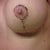 2 Weeks Post Op LEFT BREAST - This ones more settled then other.