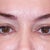 24 hours after Juvaderm injection.  I feel great about the result.  Virtually no swelling, no bruising except tiny needle marks.  Wow, Jennifer was good.