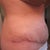 Right side view after drainage of hematoma.  Can't wait to see final results after all of the swelling subsides.