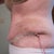The view from the left after hematoma was drained - and the doc inserted a new drain which he estimates I will have for a week.