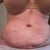 The day after my additional surgery to have the hematoma suctioned.