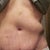 The hematoma was a long hard ridge that went from my left side up to right under my breastbone.