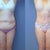 Front pic of before & 3 months after
