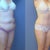 Right side of before and at 3 monthsfter