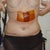 2 Days Post Op sill with Pain Pump and Drains
