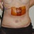 2 Days Post Op sill with Pain Pump and Drains