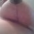 4 Weeks Post Op L Breast.