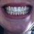 Without aligners