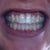 With aligners