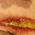 Here's the start of the incision opening up. I looked at it and freaked out. I was also afraid it was infected and it was not. The yellow stuff is what your body produces and has to be cleared away in order for the wound to heal. The wet to dry method removes the yellow and brings on the red, meaty look which is when it will start to heal from the inside out and from the sides inward.