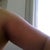 before upper arm liposuction