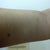 after procedure.  It looks like its a little more saggy than it originallt was.  Should I wait longer for final results?