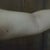 after procedure.  It looks like its a little more saggy than it originallt was.