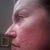 Puffy and swollen with burns