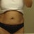 Pre-Surgery Pic 1 - Hiding the hang.