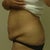 Pre-Surgery Pic 3 - Left Side View(ahhh)