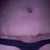 16 weeks close up of scar and belly button.