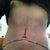 Pre Op - Mark ups, the incision will either be below or above the belly button, to be determined during surgery.