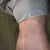 6 weeks post op