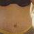 2 weeks after.. i'm still very swollen. (i can tell because my binder is leaving indents in my belly.)