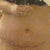 here's an after about 1 1/2 weeks later.  i'm swollen but it still looks great to me.. im very happy with my rusults.. cant wait until the swelling goes down.