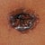7 Days Post Op Bellybutton