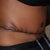 7 Days Post Op