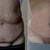 Before & After (Post op 2.5 weeks). Still really swollen