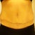 Tummy Tuck post-op