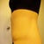 Tummy Tuck post-op