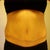Tummy Tuck post-op