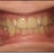Start of treatment