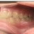 Start of treatment