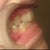 Start of treatment