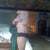 Lipo bruising, and JP drain visible