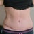 33 days po you can see how much higher my scar is on the one side to the other