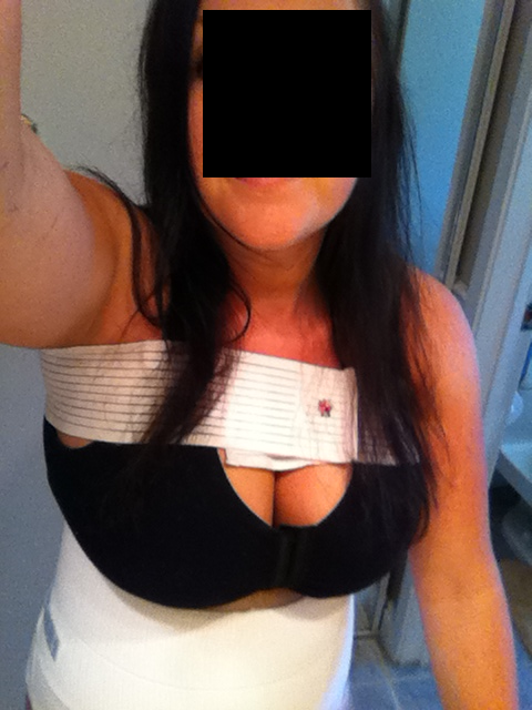 day 5 chin and neck a lil swollen band is to help settle the breast