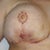 Day 2 Post Op of right breast