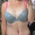 33 days post op